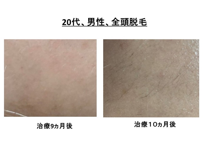 円形脱毛症　病院